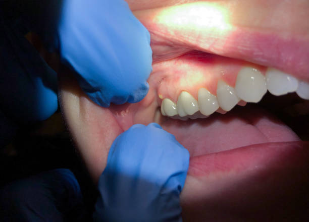 Best Broken or Chipped Tooth Repair in Fruitland Park, FL